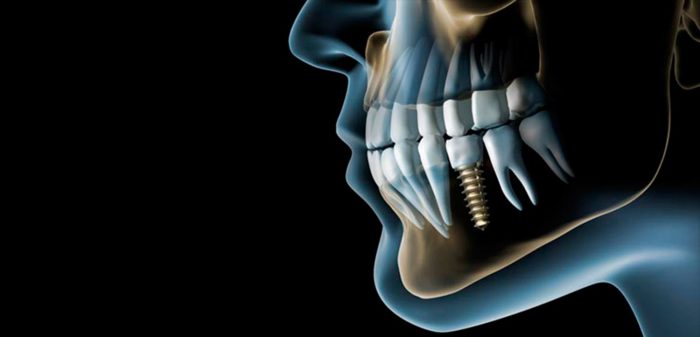 En nuestra clínica dental en Jaén hacemos también implantes