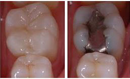 Tratamiento de la caries