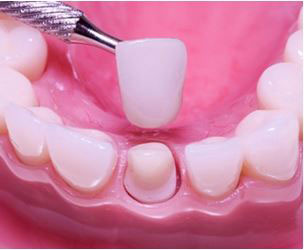 Funda dental