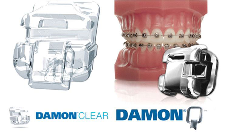 Brackets autoligables y ajustables Damonclear.