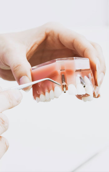 Implantes dentales en Jaén