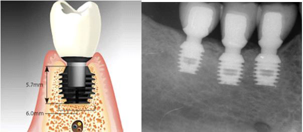 Somos especialistas en implantes en Jaén