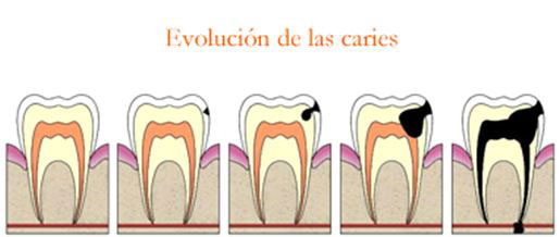 Gráfica de evolución de la caries