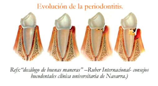 Evolución periodontitis