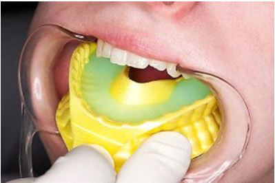 Flúor dental tópico