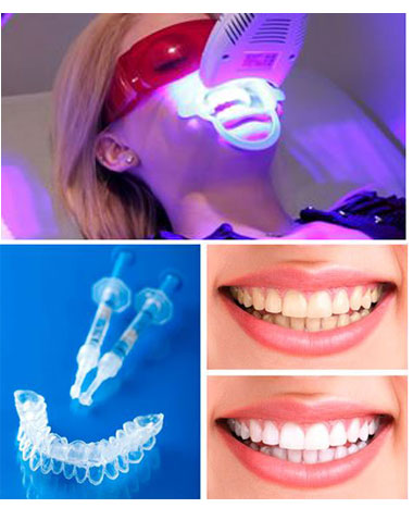 Blanqueamiento Dental Láser o con Férula - Clínica Dental Jaén