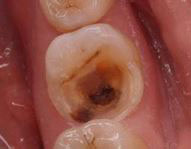 Caries profunda