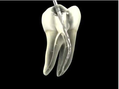 tratamiento de endodoncia paso a paso