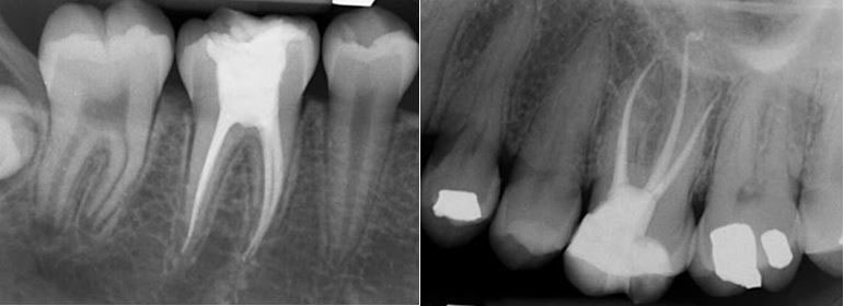 Tratamiento de endodoncia precio