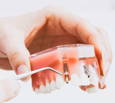 Implantes dentales en Jaén