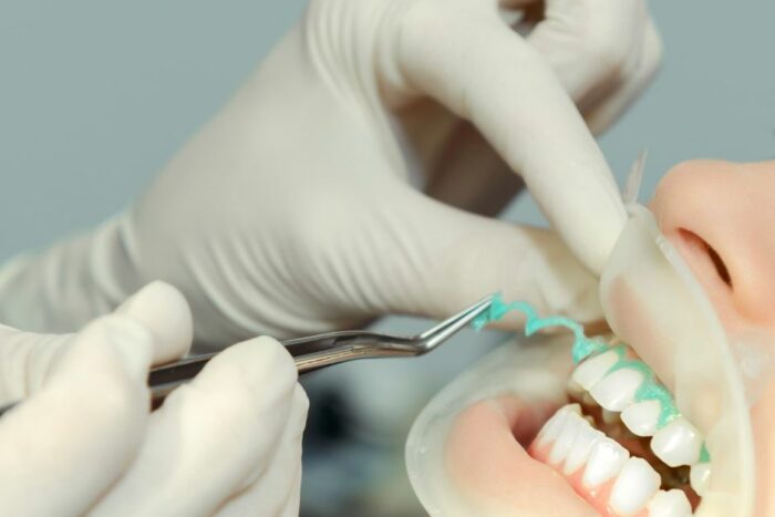 blanqueamiento dental larser dentista jaen profesional clinica dental