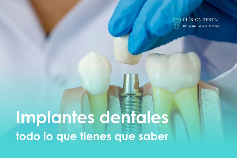implantes dentales jaen clinica dental dr jesus garcia merino dentista