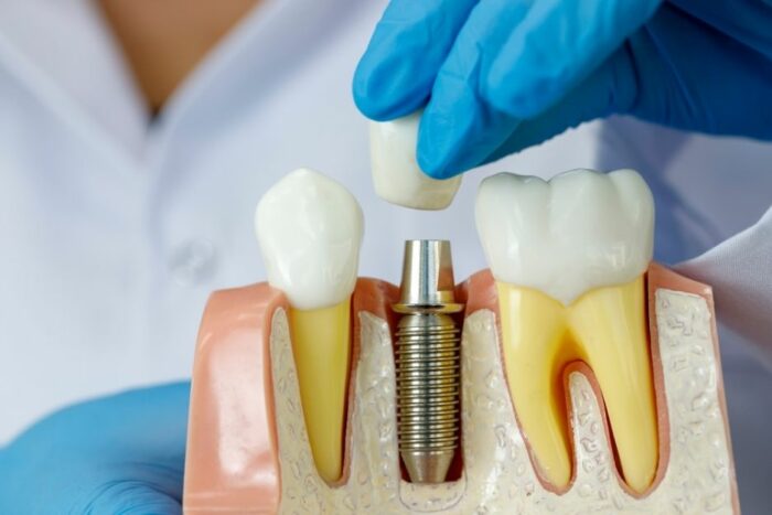 implantes dentales jaen dr jesus garcia merino clinica dental dentista