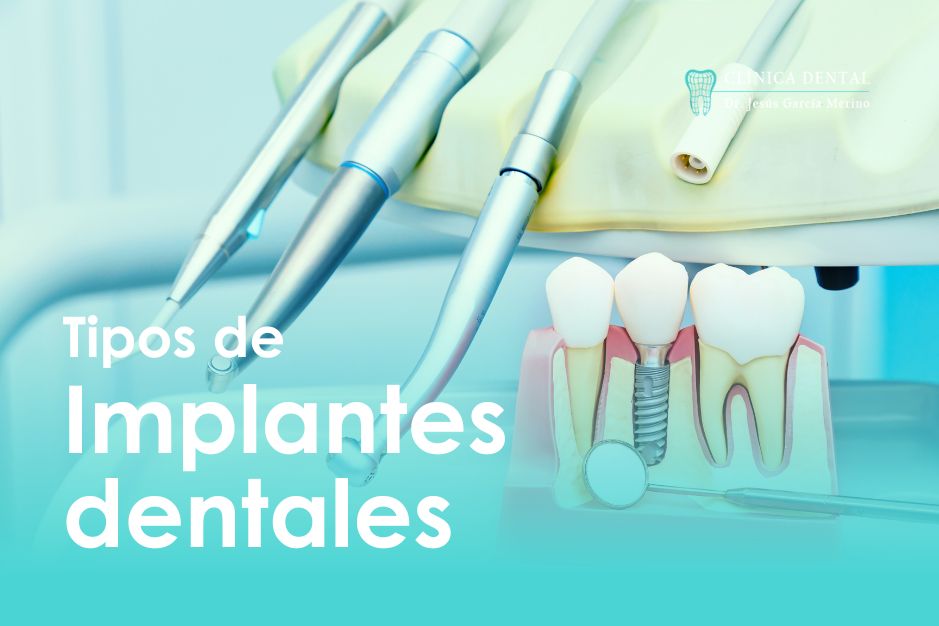 tipos de implantes dentales jaen clinica dental implantologia dr Jesus García Merino