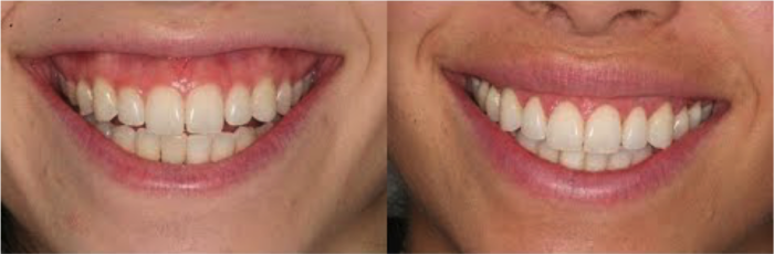 Tratamiento de la sonrisa gingival con ácido hialurónico antes y despues