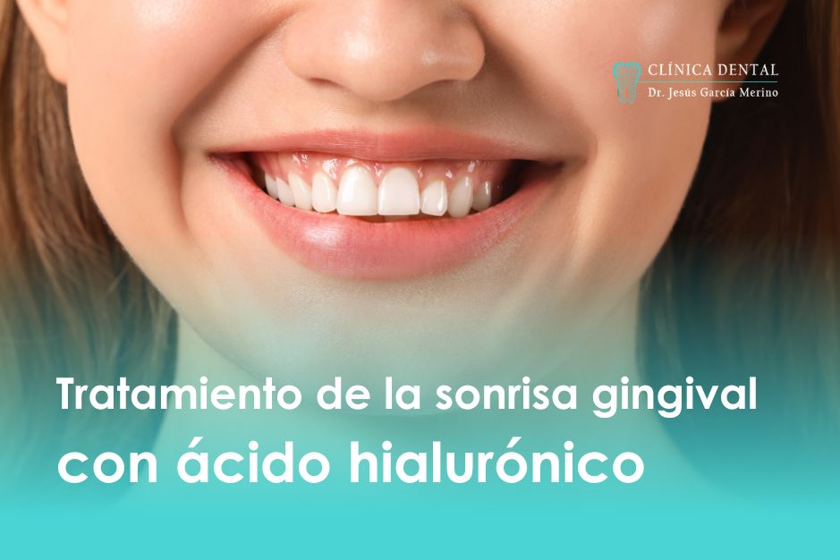 Tratamiento de la sonrisa gingival con ácido hialurónico