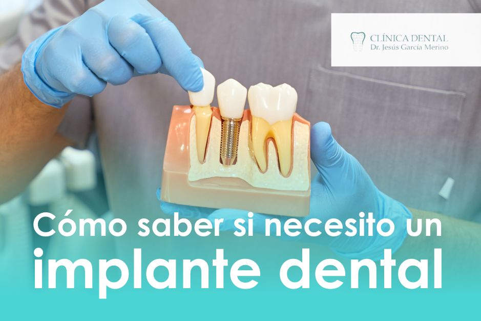Cómo saber si necesito un implante dental Jaén Clinica Dental Dentista