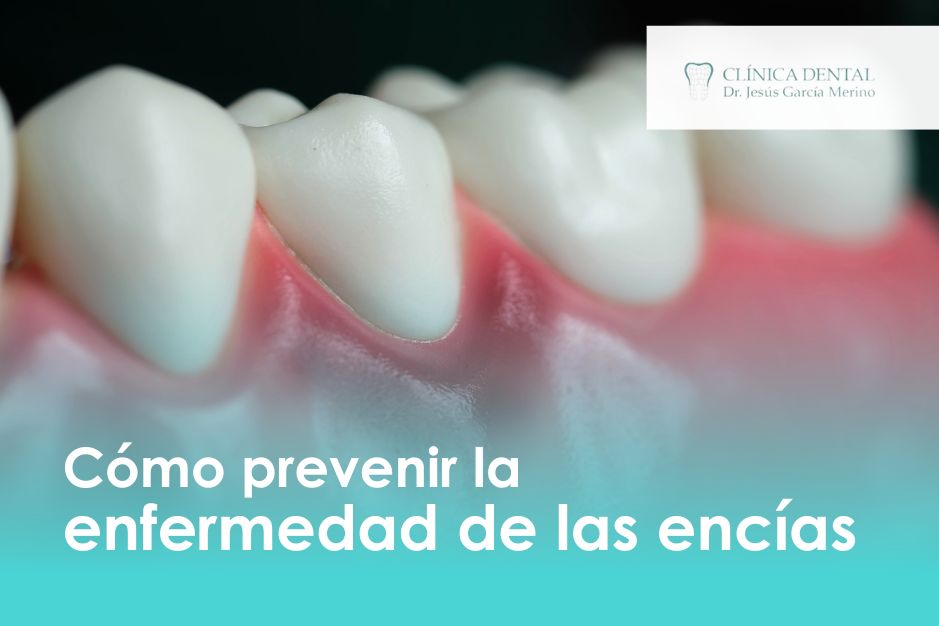 prevenir la enfermedad de las encías Clinica Dental Jaén Dentista