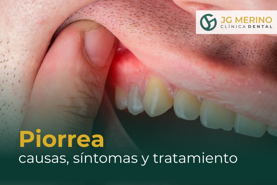 Piorrea causas, síntomas y tratamiento Clinica Dental Jaen dentista periodontitis