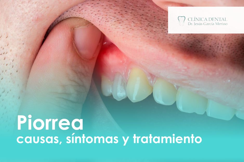 Piorrea causas, síntomas y tratamiento Clinica Dental Jaen dentista periodontitis