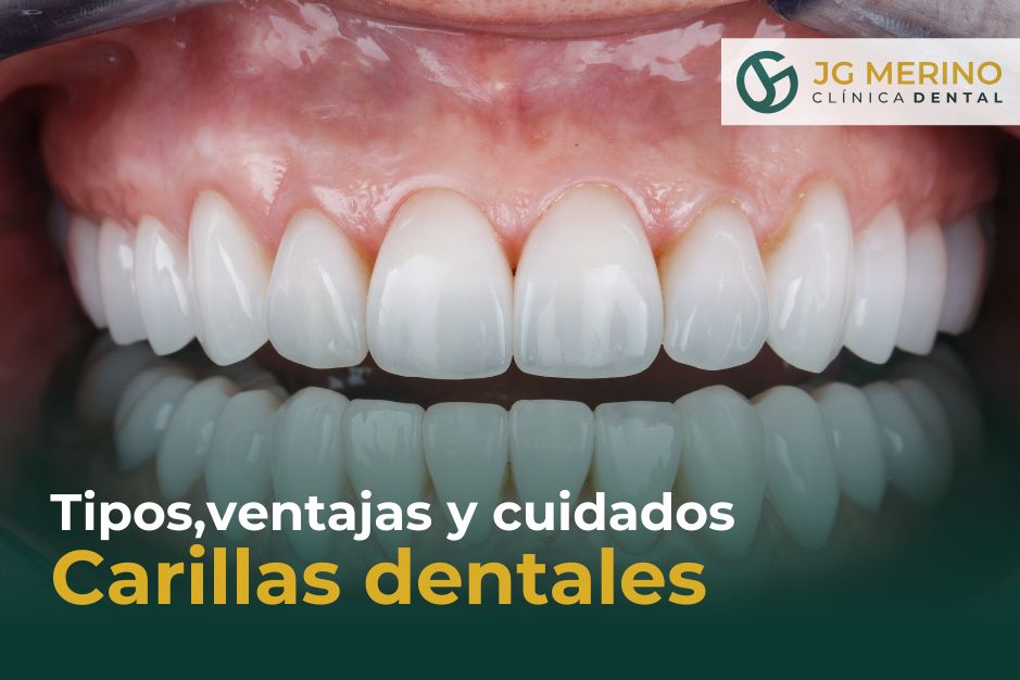 Carillas dentales en Jaén tipos, ventajas y cuidados clinica dental jaen dentista DR Jesus García Merino