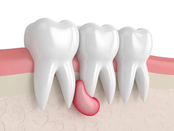 Síntomas de un absceso dental dentista jaen odontologo clinica dental flemon