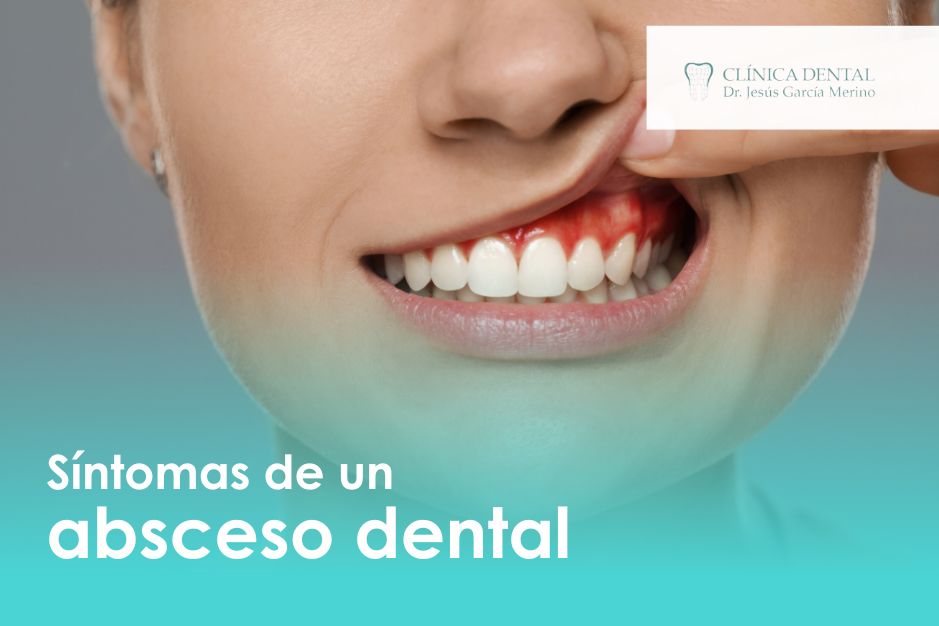 Síntomas de un absceso dental dentista jaen odontologo clinica dental