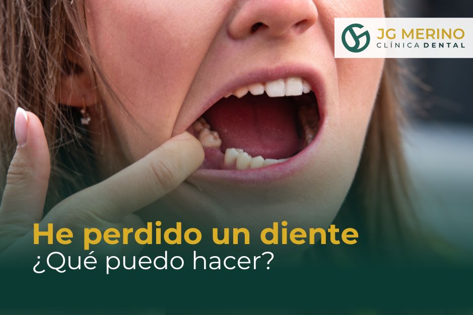 He perdido un diente qué puedo hacer clinica dental jaen dentista