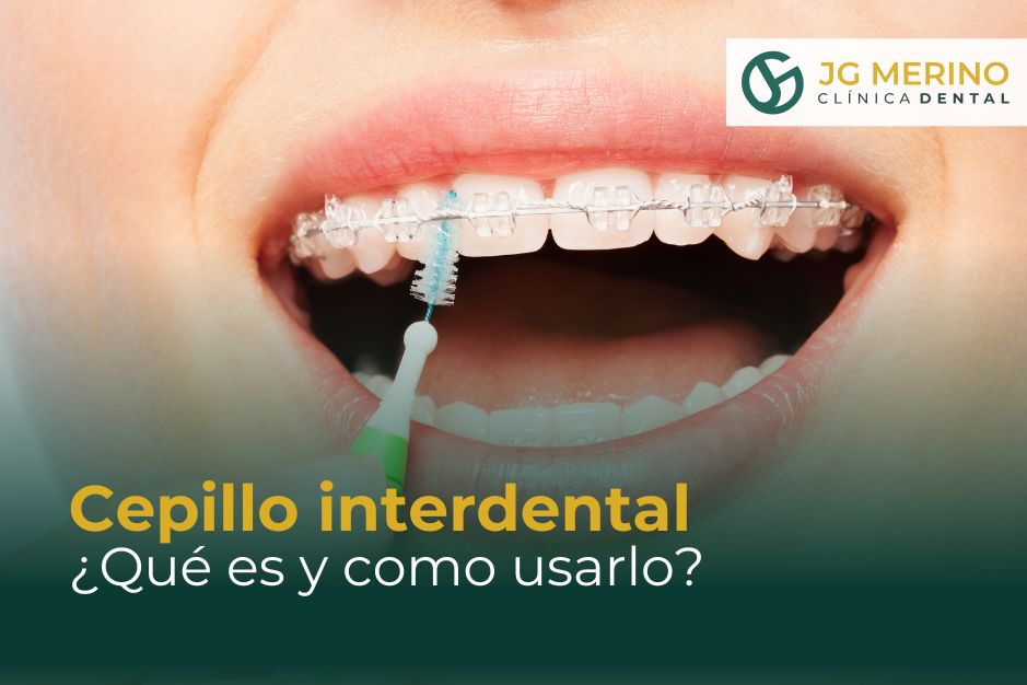 Cepillo interdental qué es y cómo se usa clinica dental jaen dr jesus garcia merino dentista