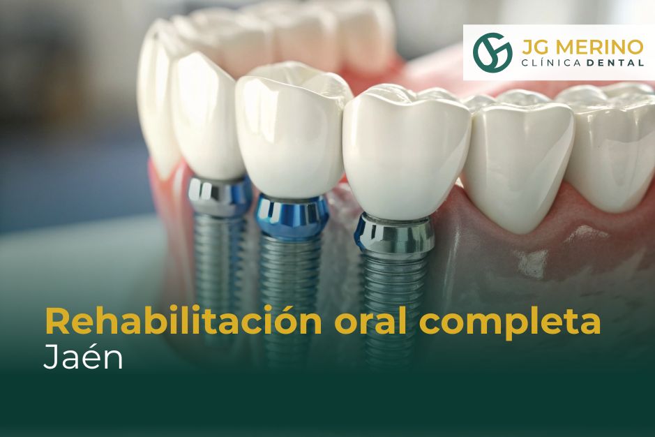 Rehabilitación oral completa Jaén Clinica Dental Dr. Jesus García Merino Implantes dentales sin dolor cirugia guiada tecnología