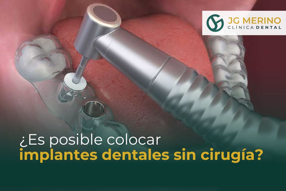Es posible colocar implantes dentales sin cirugía Clinica Dental Jaén dentista implantologia especialista