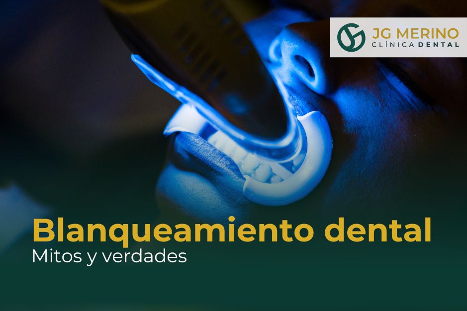Blanqueamiento dental mitos y verdades Clinica Dental Jaen DR Jesus García Merino dentista
