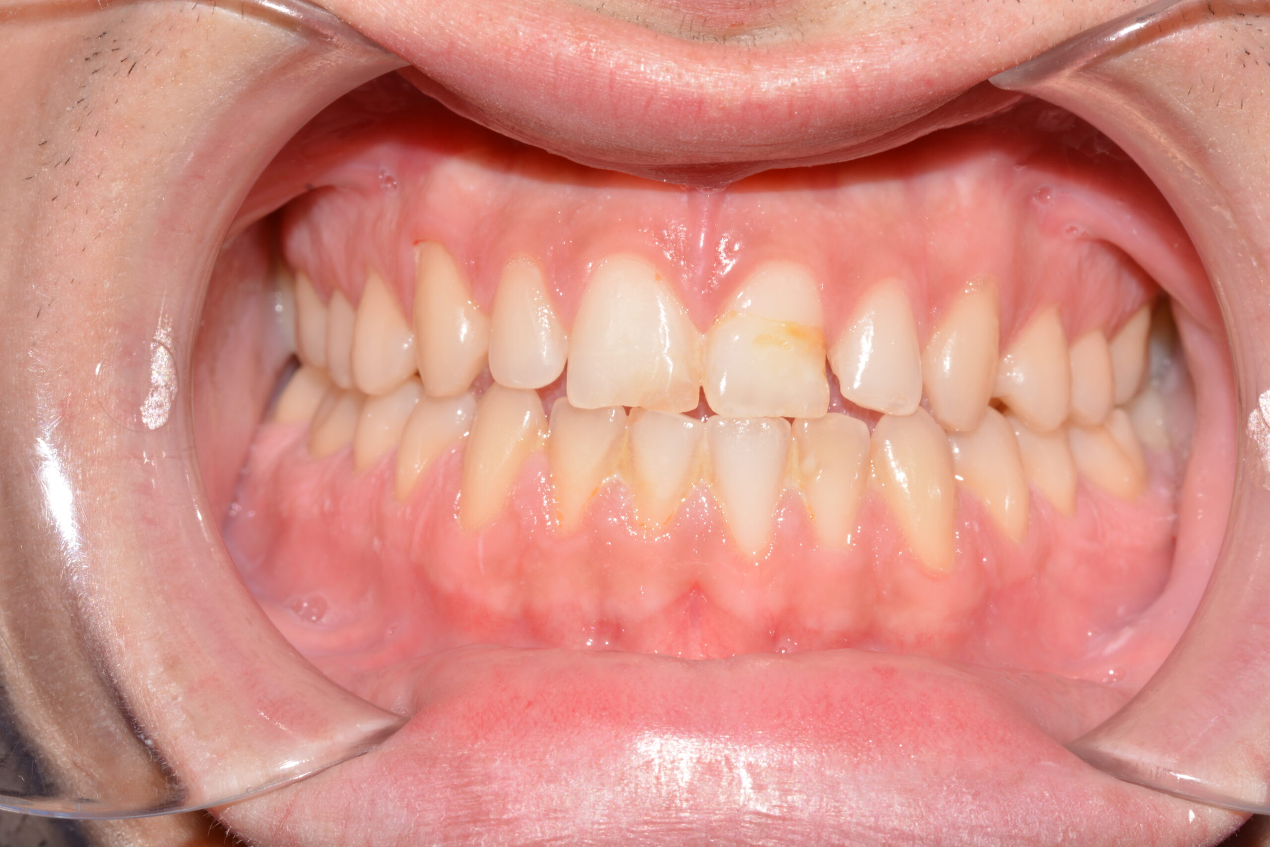 Carillas dentales antes clinica dental jaen