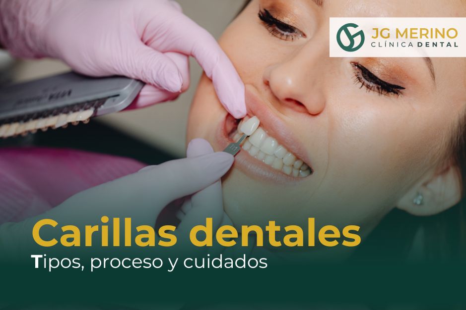 Carillas dentales tipos proceso clinica dental jaen dentista porcelana composite diseño de sonrisa