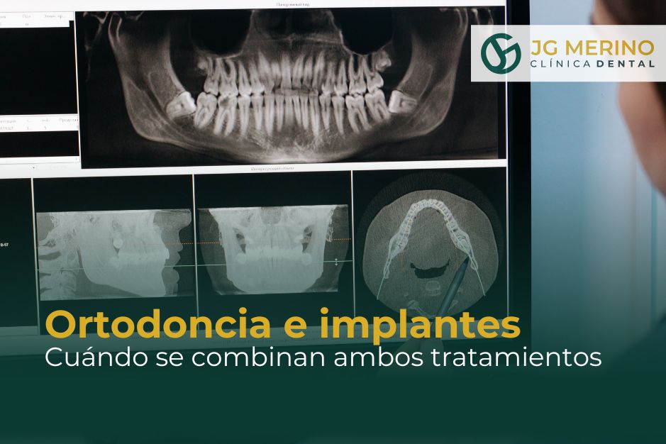 Ortodoncia e implantes cuándo se combinan ambos tratamientos Clinica Dental Jaen dr Jesus García Merino dentista