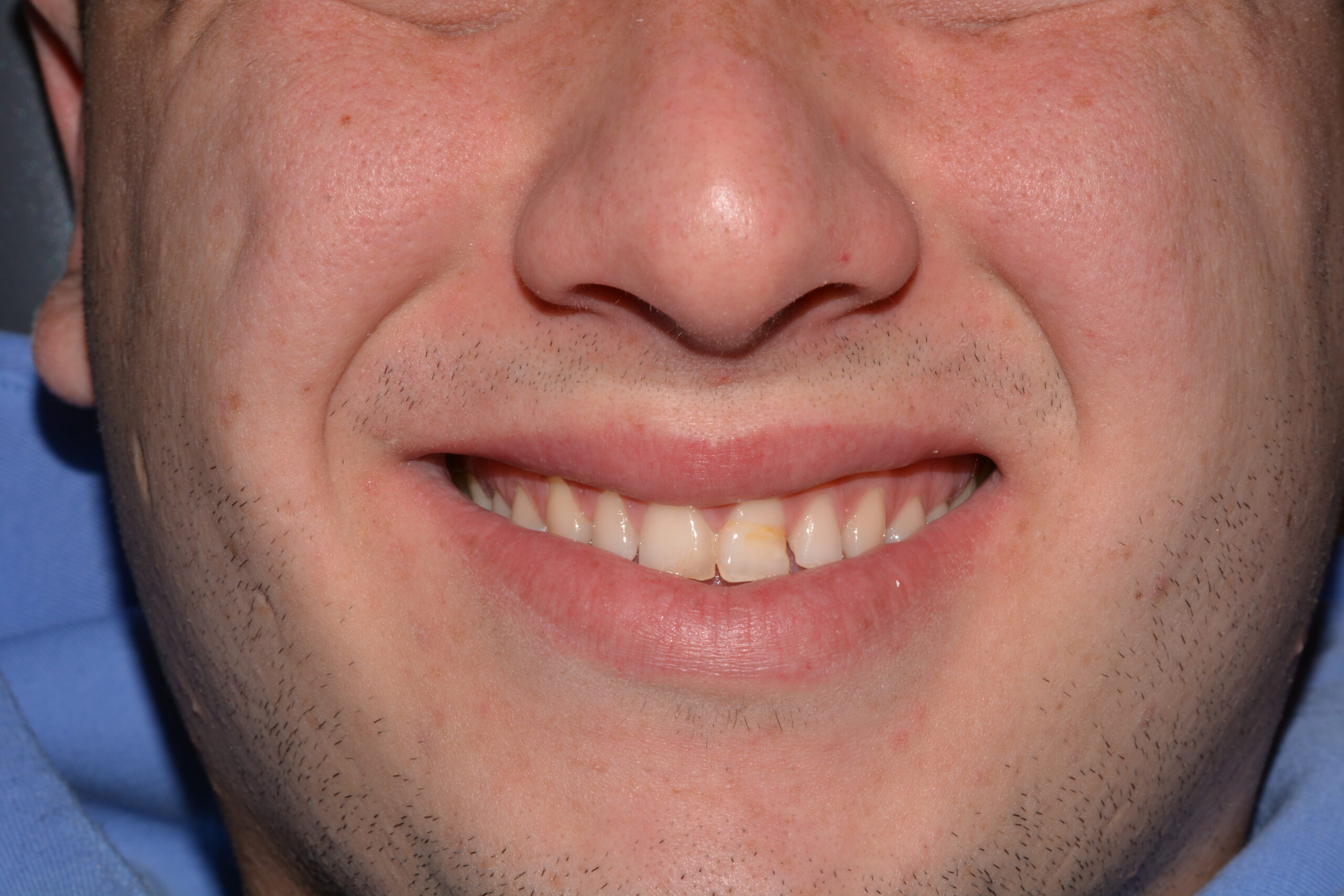 antes y despues carillas dentales jaen clinica dental jesus garcía merino