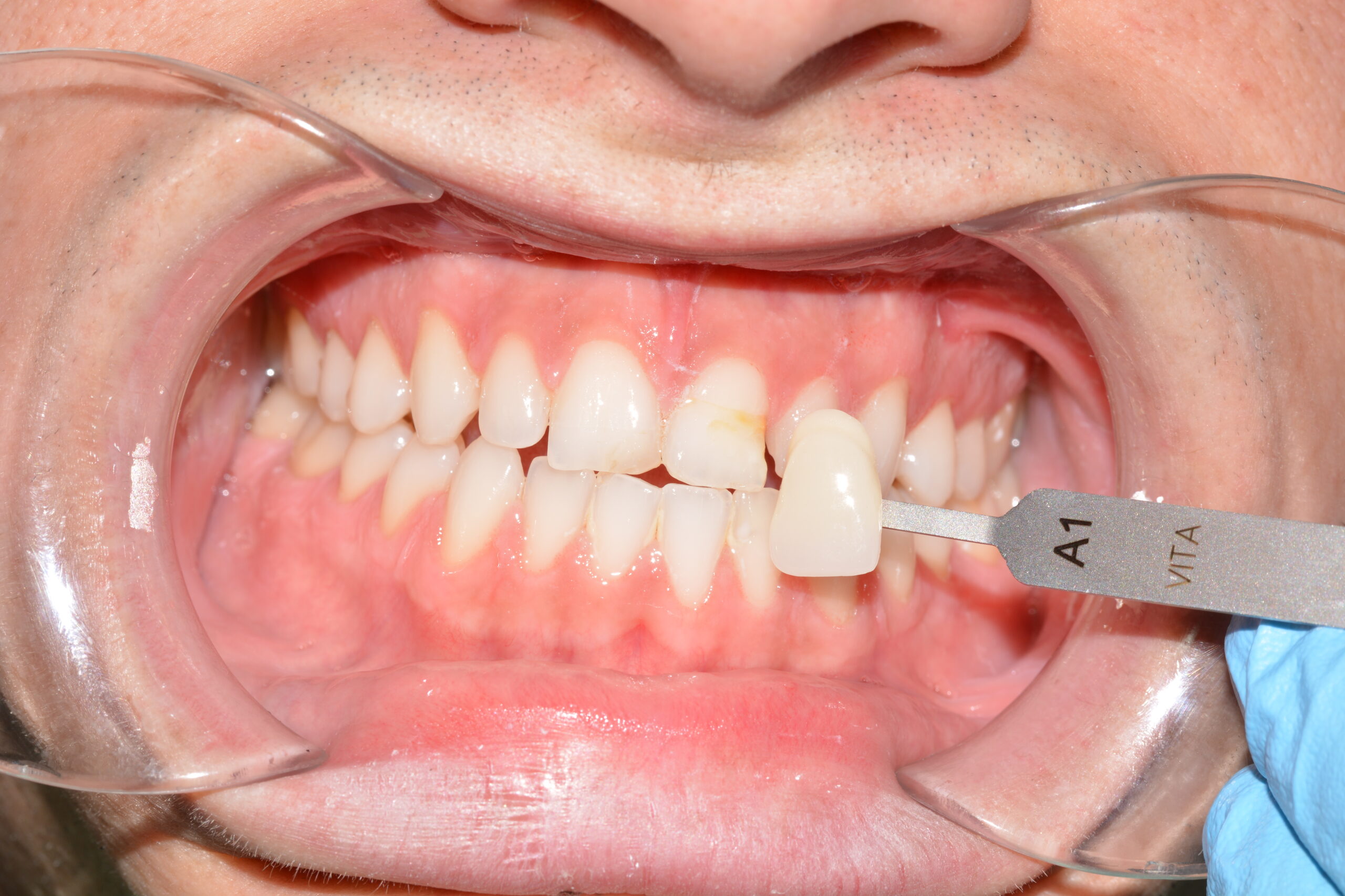 carillas dentales blanqueamiento dental previo clinica dental jaen