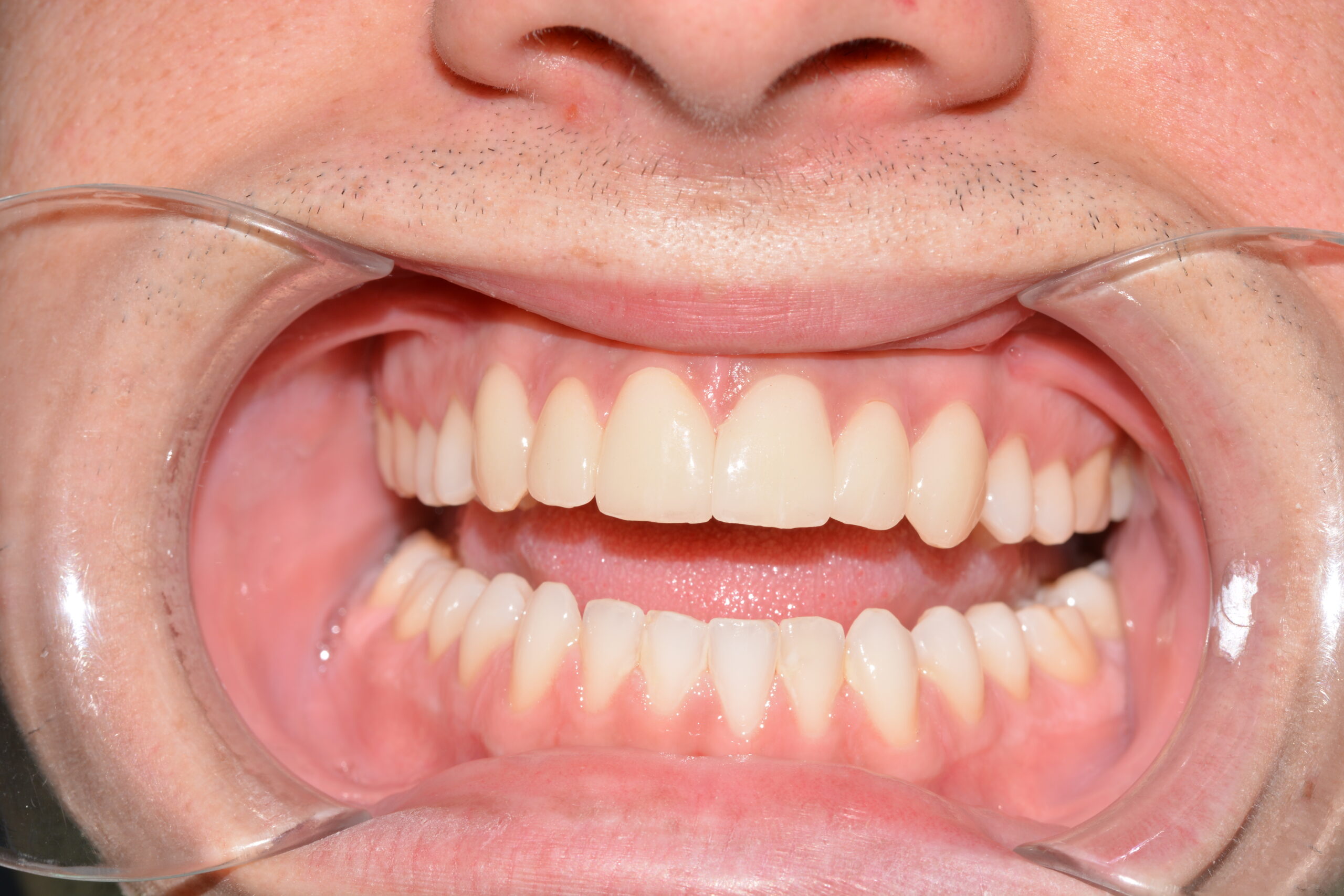 carillas dentales clinica dental jaen dr jesus garcía merino estetica dental