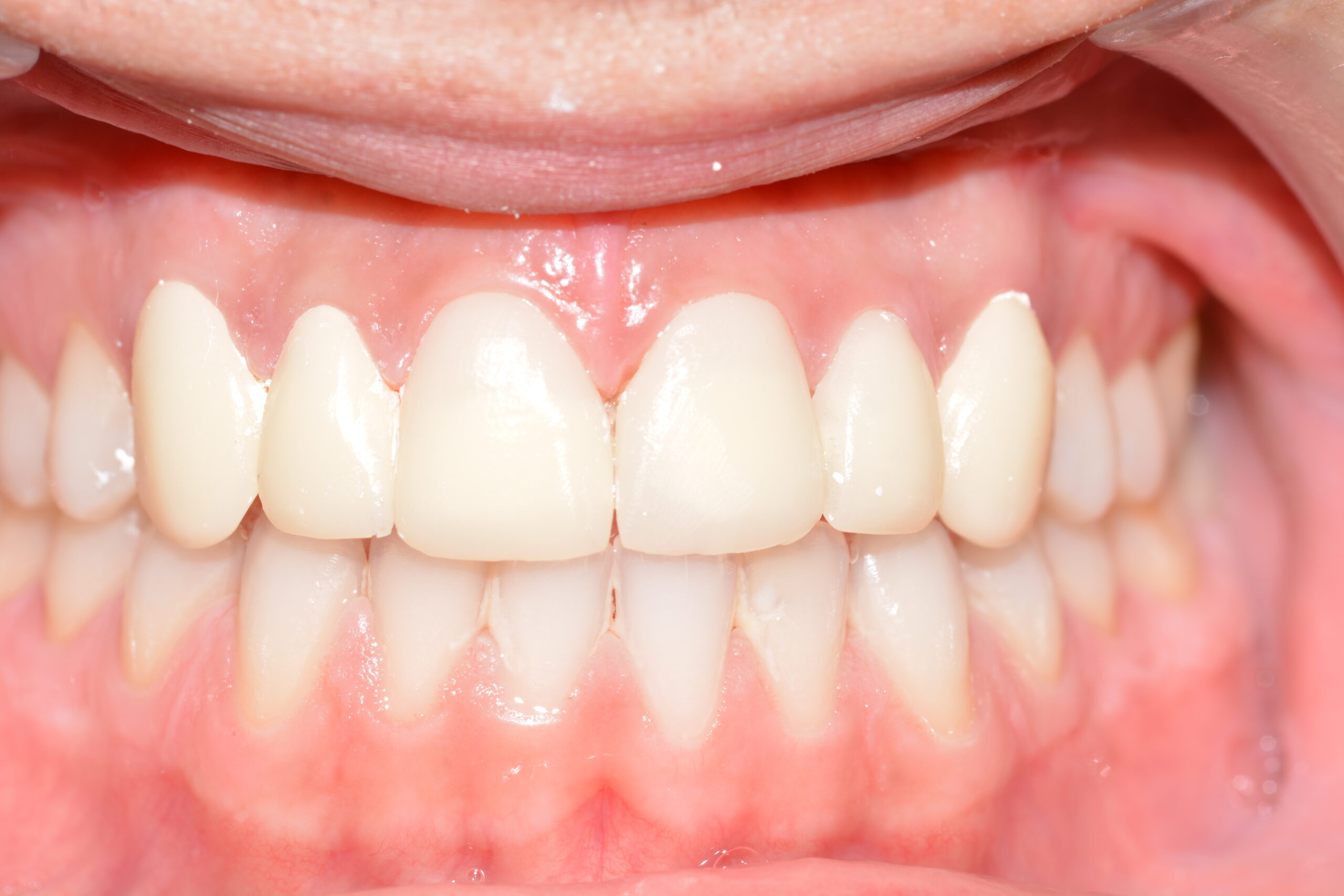 carillas dentales clinica dental jaen jesus garcía merino