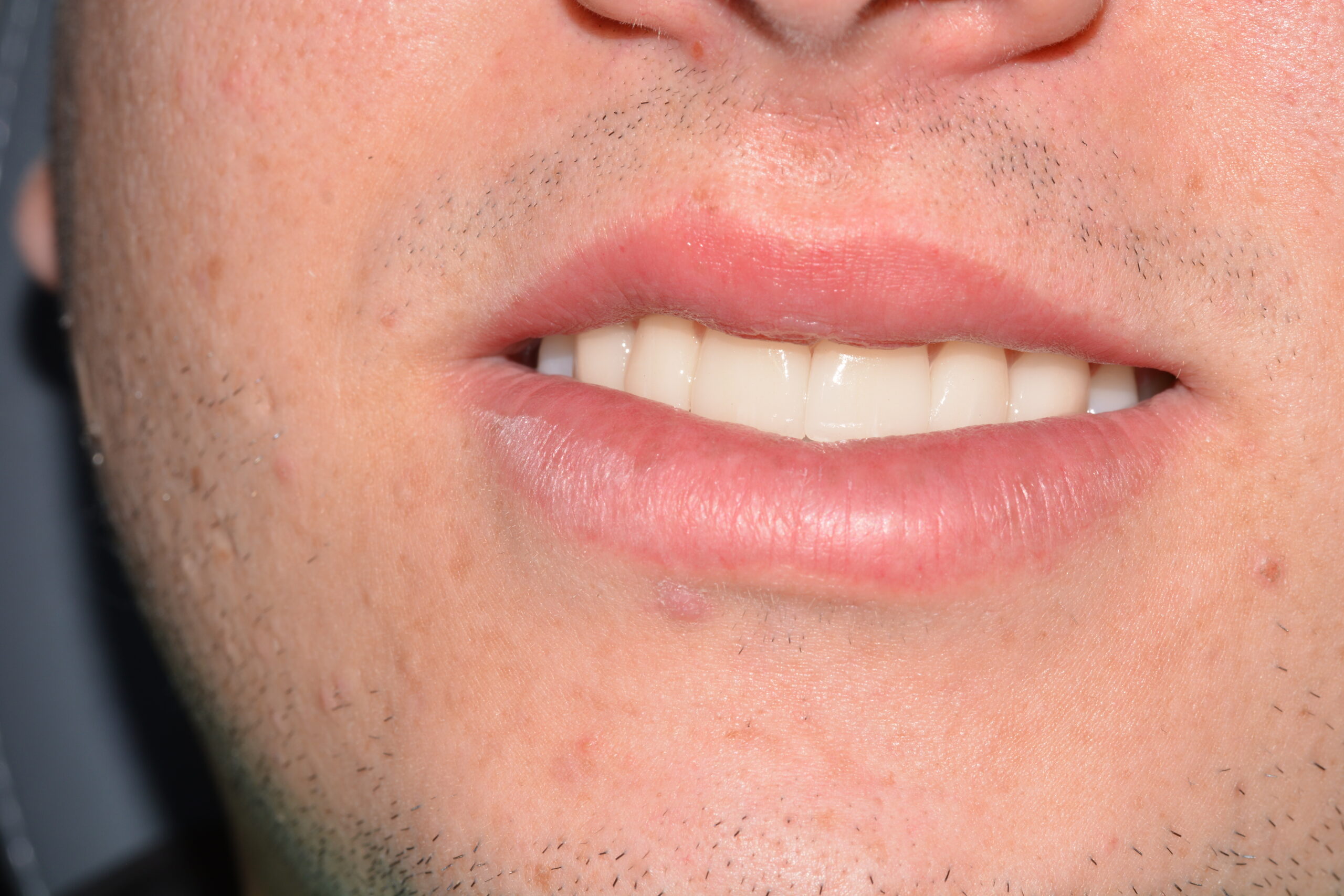 carillas dentales clinica dental jaen