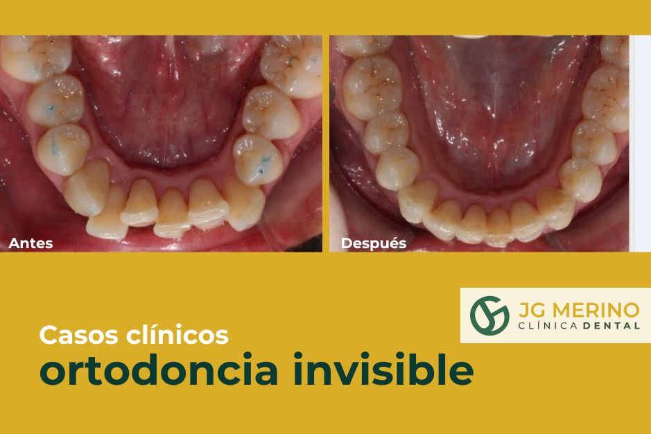 Caso apiñamiento con ortodoncia invisible en Jaén Clinica dental jaen tratamiento (2)