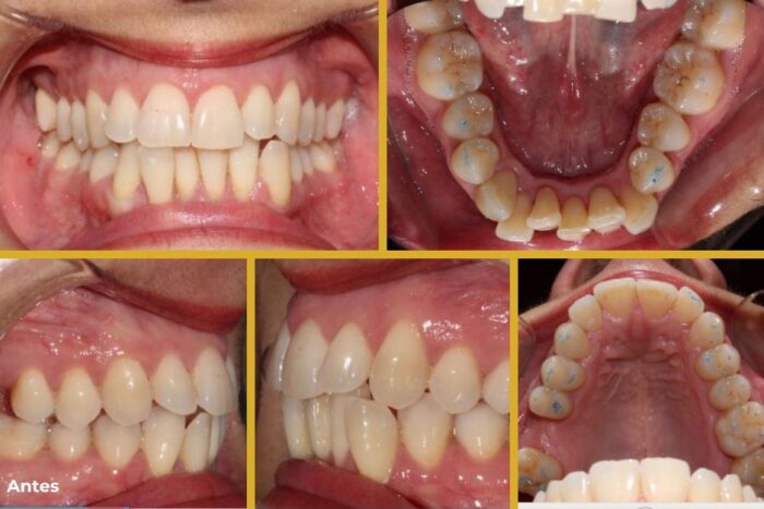 Caso apiñamiento con ortodoncia invisible en Jaén Clinica dental jaen tratamiento antes