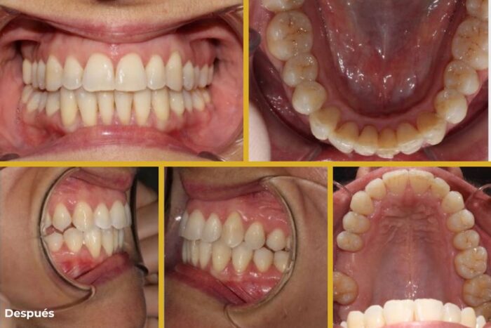 Caso apiñamiento con ortodoncia invisible en Jaén Clinica dental jaen tratamiento despues resultado