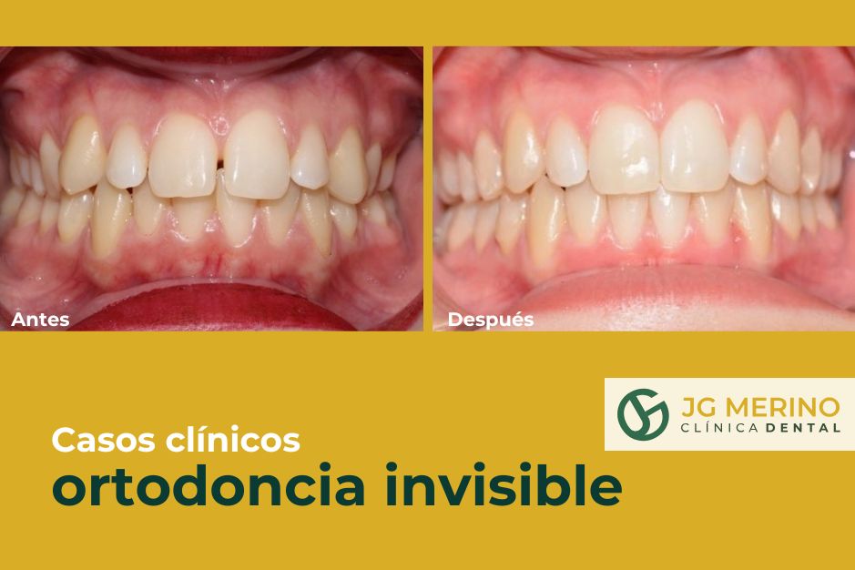 Caso de diastemas con ortodoncia invisible en Jaén clinica dental jaen dr jesus garcia merino menos