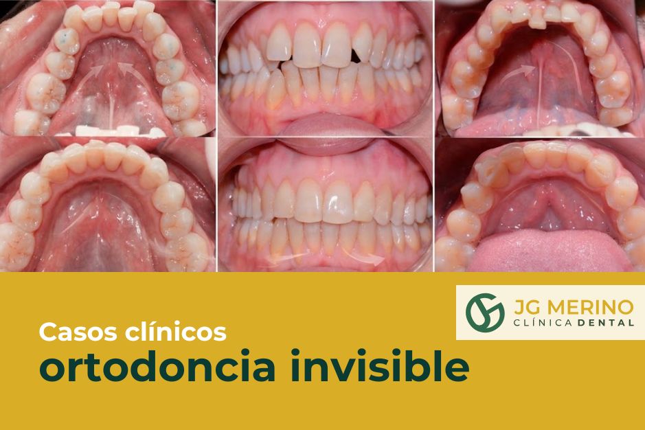 casos reales ortodoncia invisible jaen clinica dental jesus garcía merino 3d