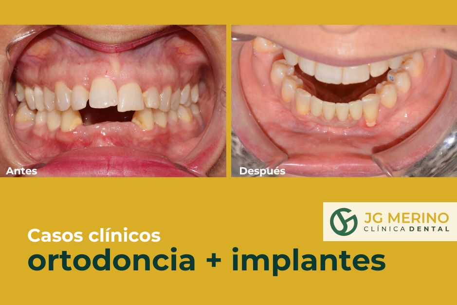 caso clinico rehabilitacion oral ortodonia implantologia clinica dental jaen dentista